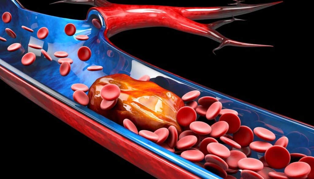 Illustration of Deep Vein Thrombosis or Blood Clots Embolism 247284976