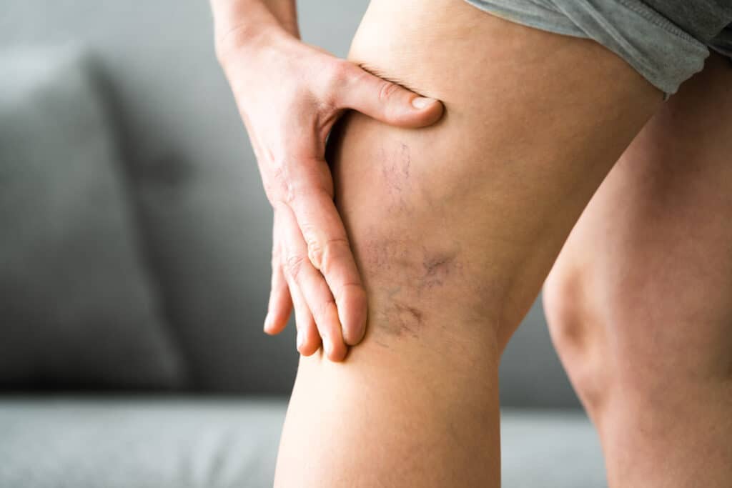 Varicose Veins on Legs 409540572